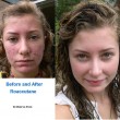 Before & After Roaccutane