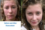 Before & After Roaccutane